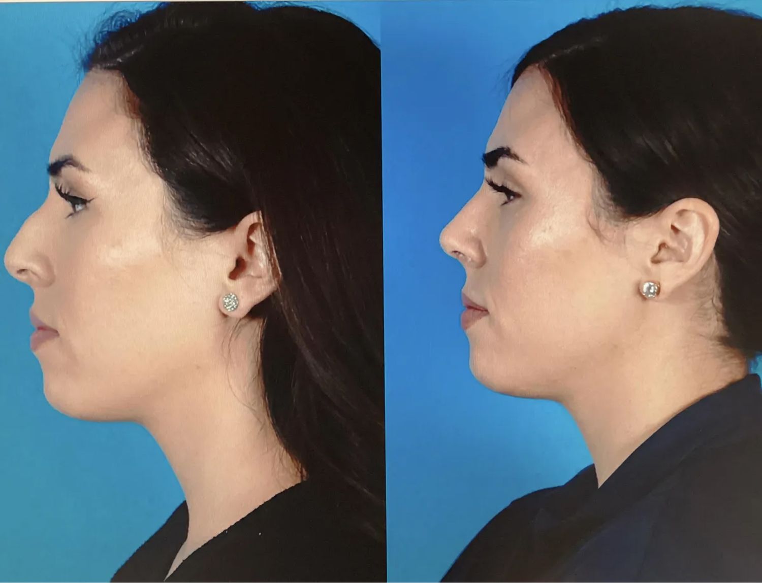 Rhinoplasty Before & After
