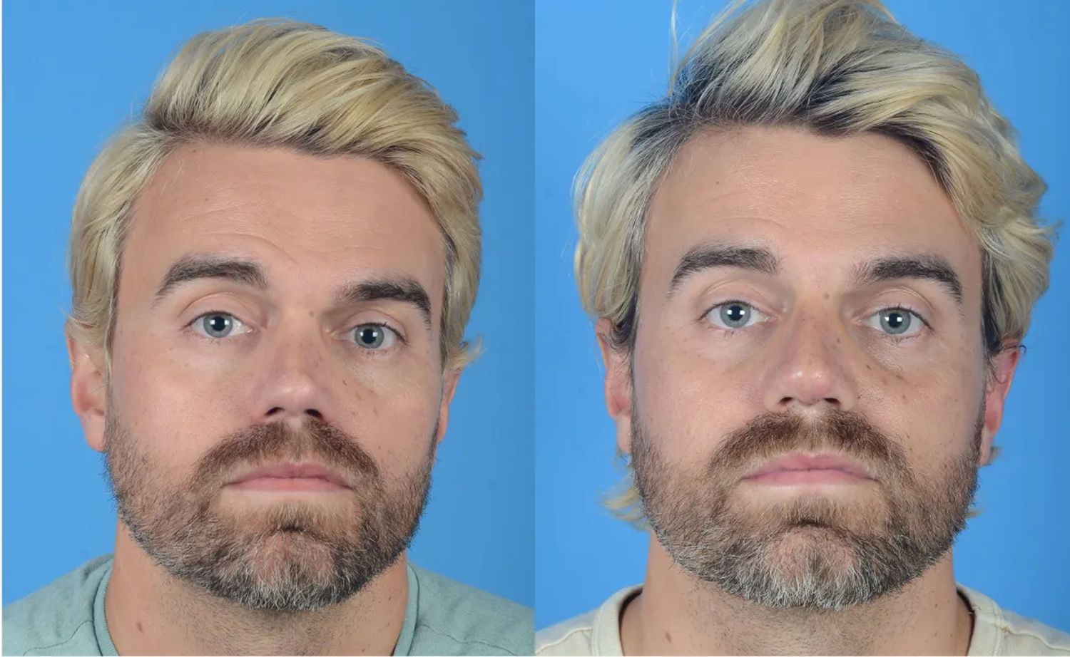 Rhinoplasty Before & After