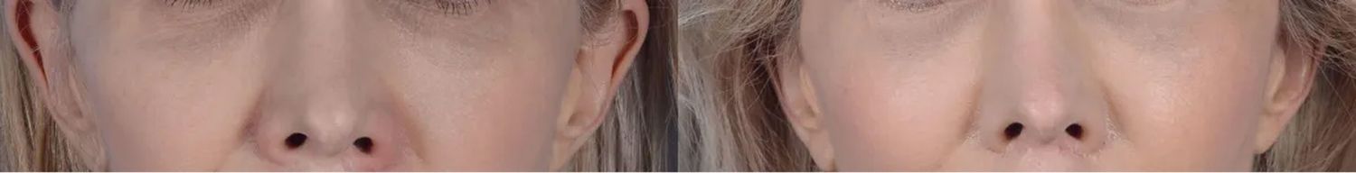 Chin Cheeks Before & After