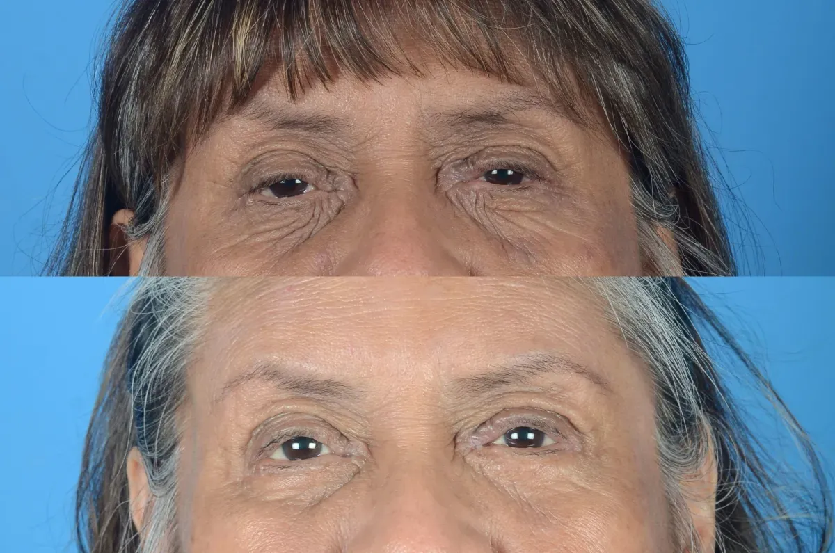 Lower Blepharoplasty Before & After