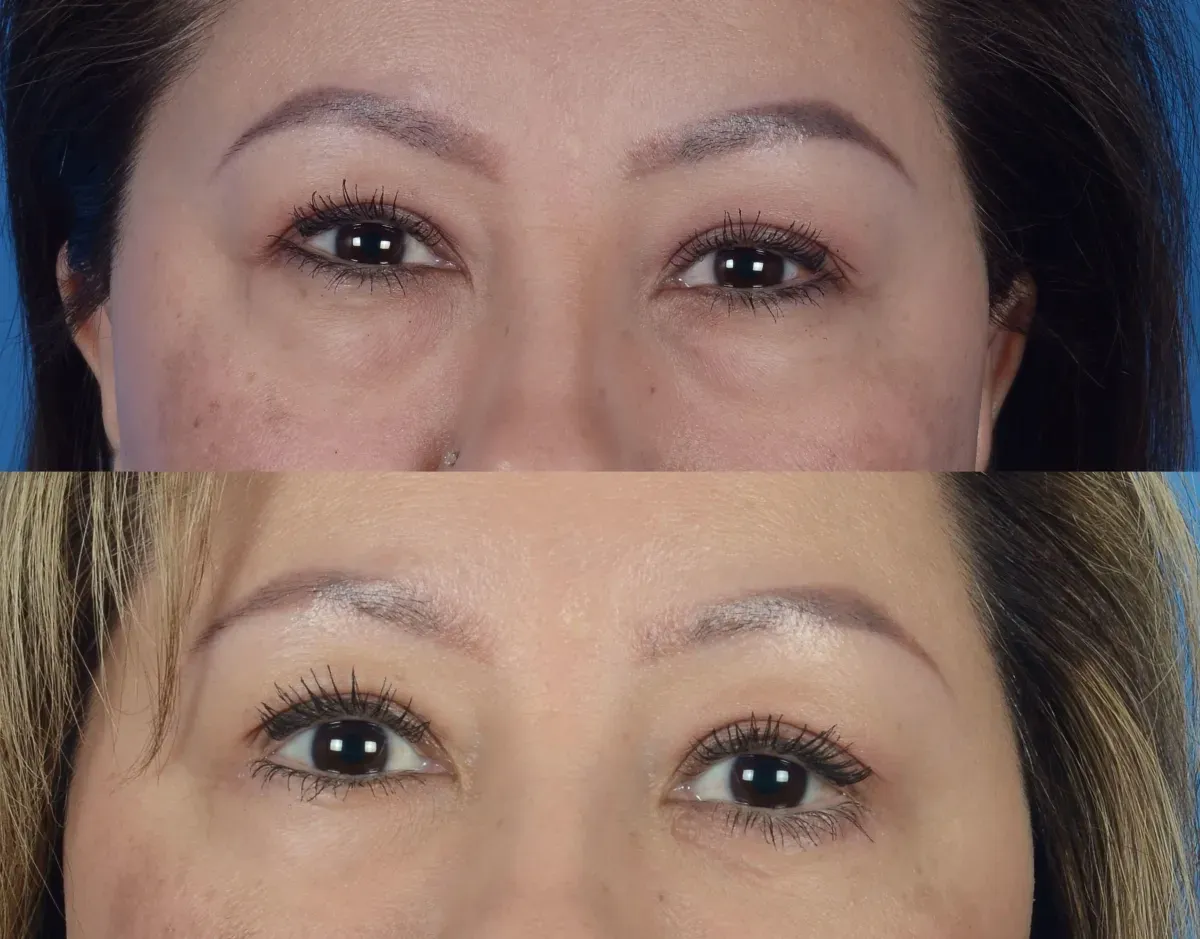 Lower Blepharoplasty Before & After